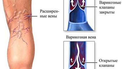 здоровые вены и варикозное расширение вен