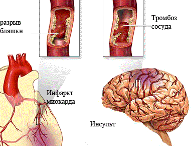 инфаркт и инсульт