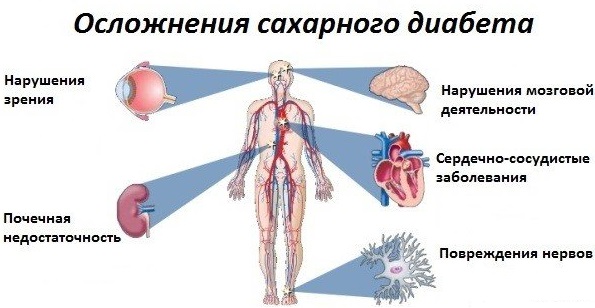 осложнения сахарного диабета: гангрена, инсульт, потеря зрения, отказ почек..