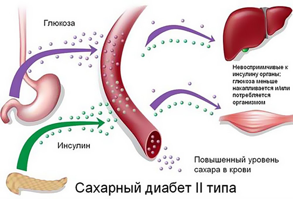 механизм возникновения сахарного диабета 2-го типа
